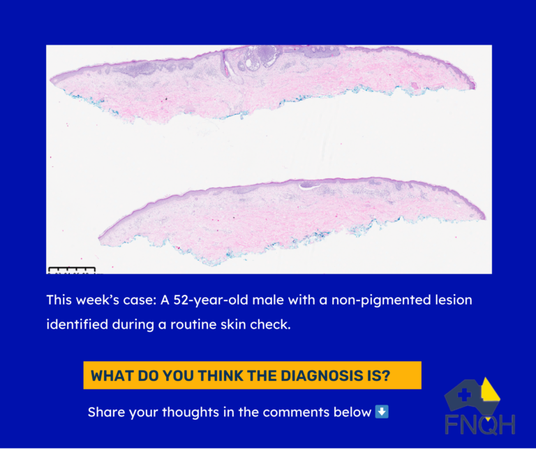 52M Superficial Basal Cell Carcinoma